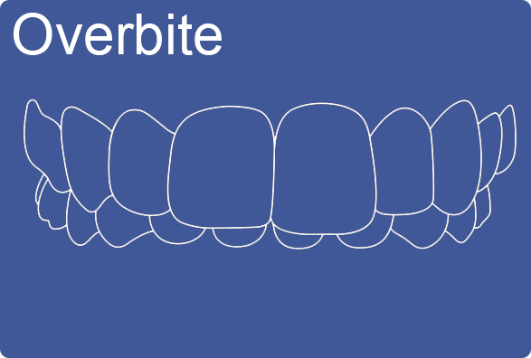 Invisalign can fix overbite
