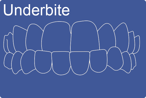 Invisalign can fix underbite