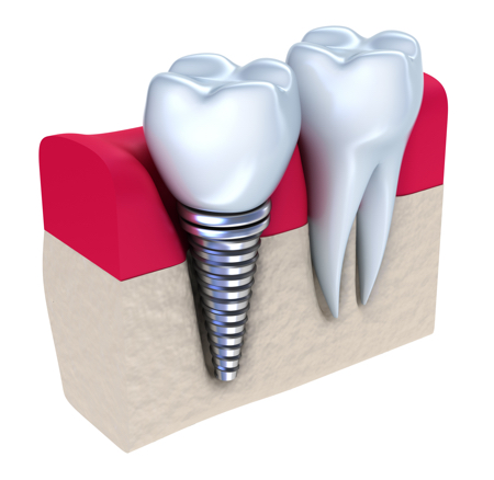 Dental Implants Milton