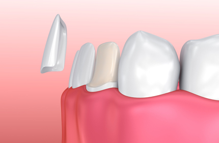 Porcelain Veneers installation