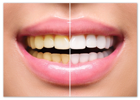 Teeth Whitening Milton Ontario